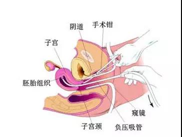 中期引产指在妊娠12周—24周,用人工的办法中止妊娠叫做妊娠中期引产.